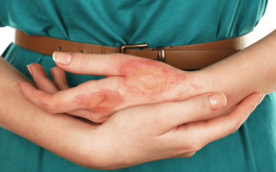 Treating Burn Injuries and the Negative Effects of Home Remedies